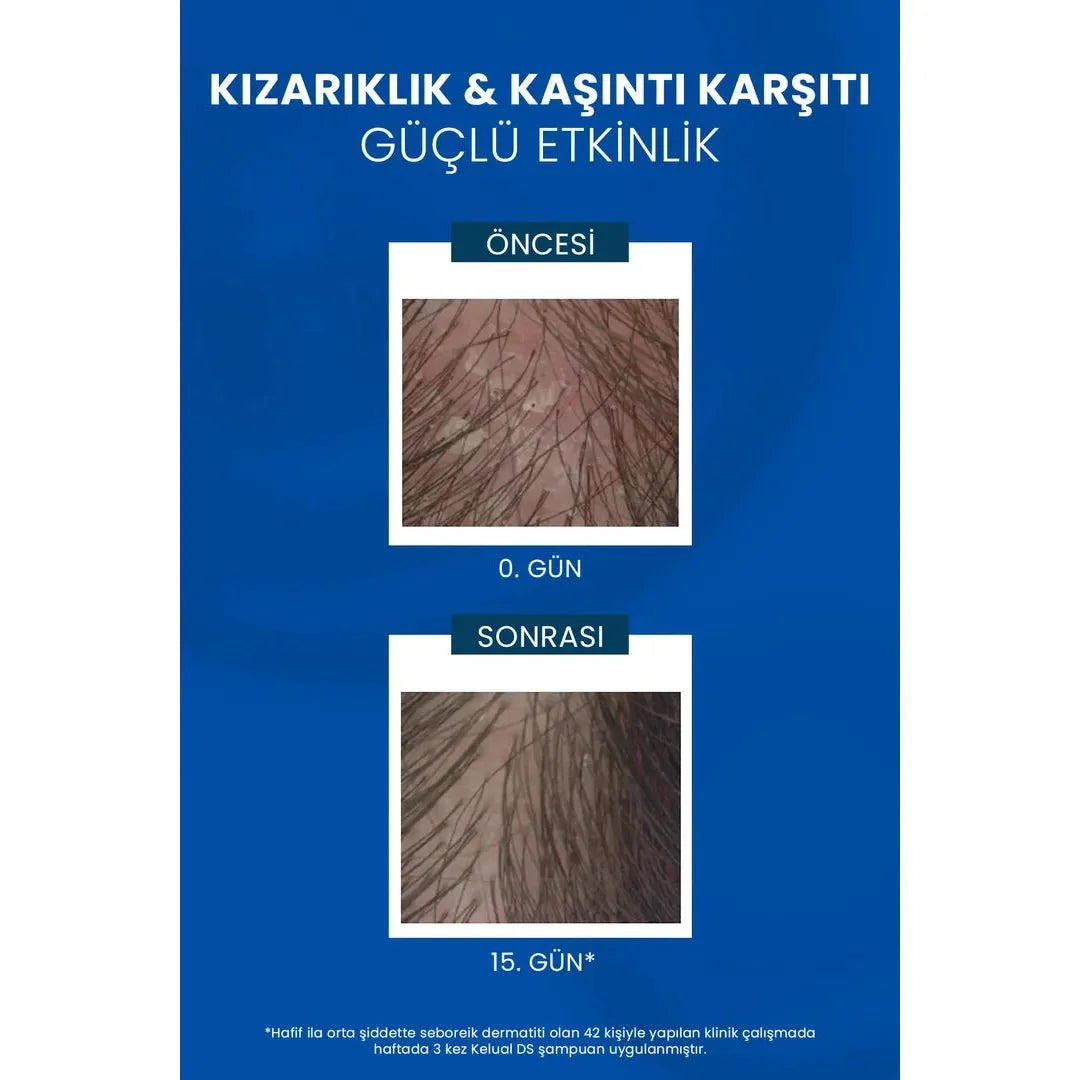 Ducray Kelual DS Shampoo Kepek Karşıtı Şampuan 100 ml